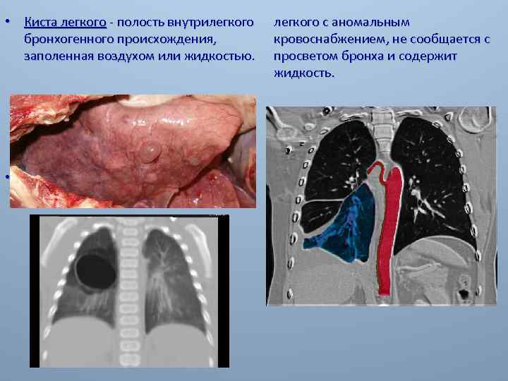  • Киста легкого - полость внутрилегкого бронхогенного происхождения, заполенная воздухом или жидкостью. •