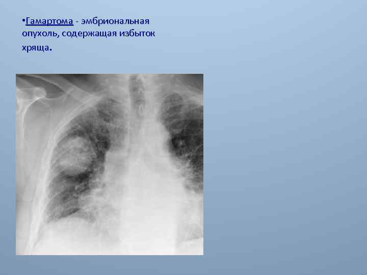  • Гамартома - эмбриональная опухоль, содержащая избыток хряща. 