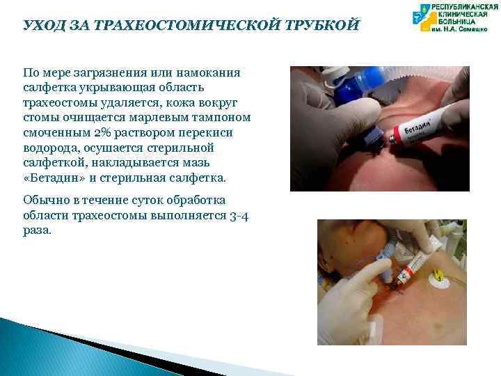 УХОД ЗА ТРАХЕОСТОМИЧЕСКОЙ ТРУБКОЙ По мере загрязнения или намокания салфетка укрывающая область трахеостомы удаляется,