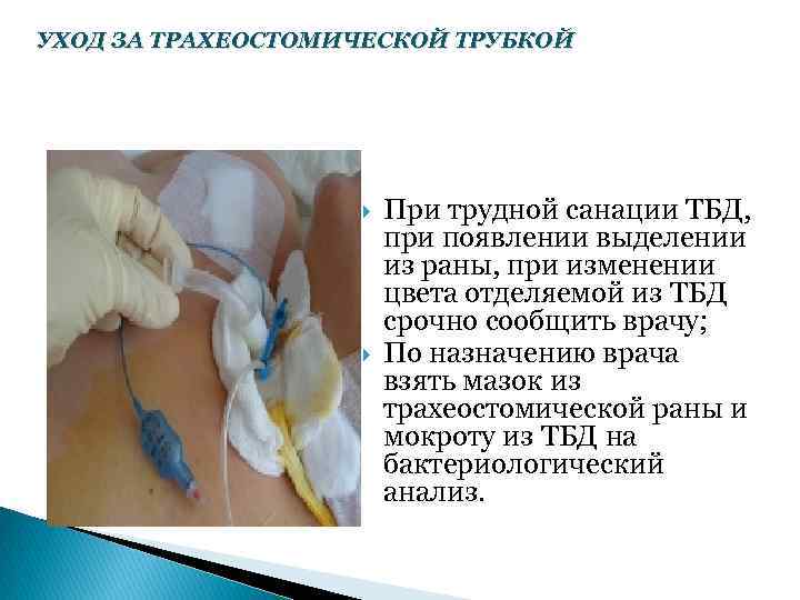 УХОД ЗА ТРАХЕОСТОМИЧЕСКОЙ ТРУБКОЙ При трудной санации ТБД, при появлении выделении из раны, при