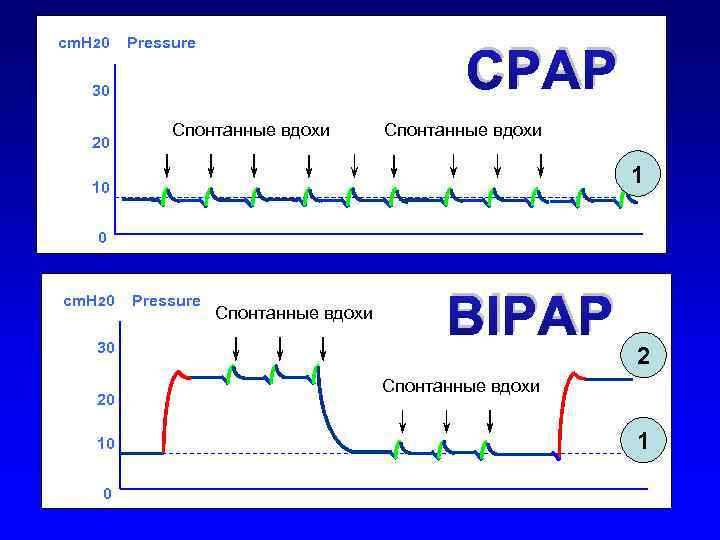 cm. H 20 Pressure CPAP 30 20 Спонтанные вдохи 1 10 0 cm. H