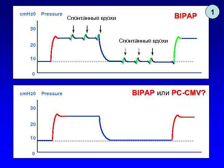 cm. H 20 Pressure BIPAP Спонтанные вдохи 30 Спонтанные вдохи 20 10 0 cm.