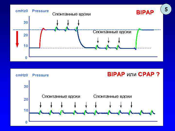 cm. H 20 Pressure BIPAP Спонтанные вдохи 30 Спонтанные вдохи 20 10 0 cm.