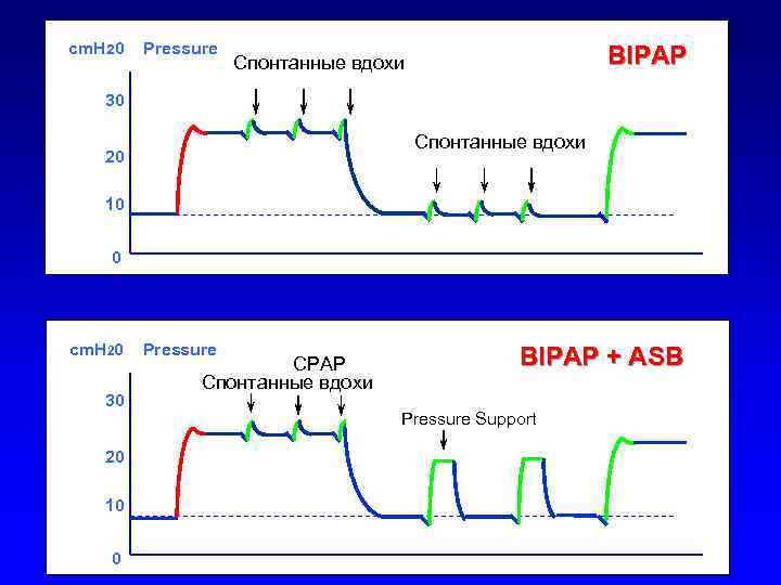 cm. H 20 Pressure BIPAP Спонтанные вдохи 30 Спонтанные вдохи 20 10 0 cm.