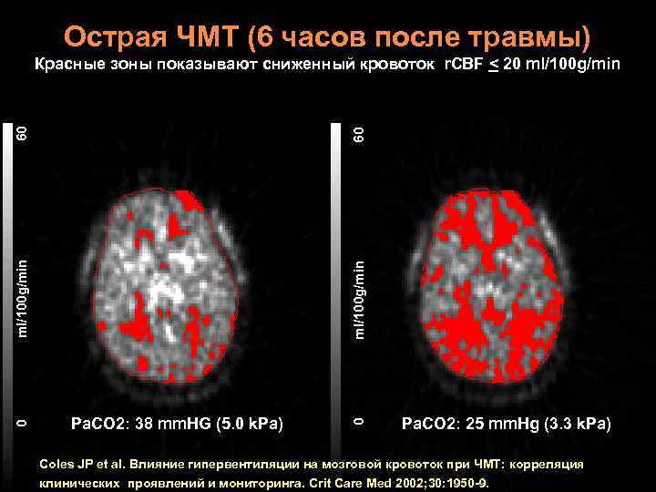 Острая ЧМТ (6 часов после травмы) ml/100 g/min Pa. CO 2: 38 mm. HG