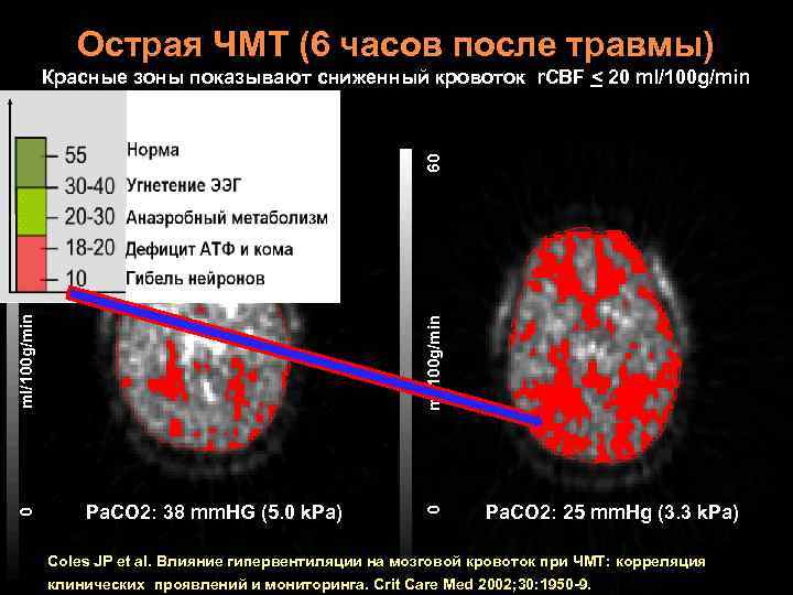 Острая ЧМТ (6 часов после травмы) ml/100 g/min Pa. CO 2: 38 mm. HG