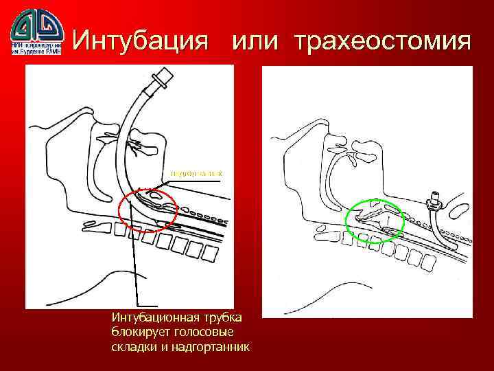 Ивл через трахеостому. Трахеостома интубация. Интубация или трахеостомия. Интубация трахеи трахеостомия. Интубация через трахеостому.