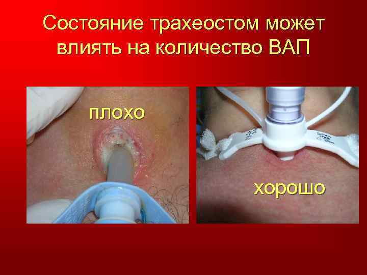 Состояние трахеостом может влиять на количество ВАП плохо хорошо 