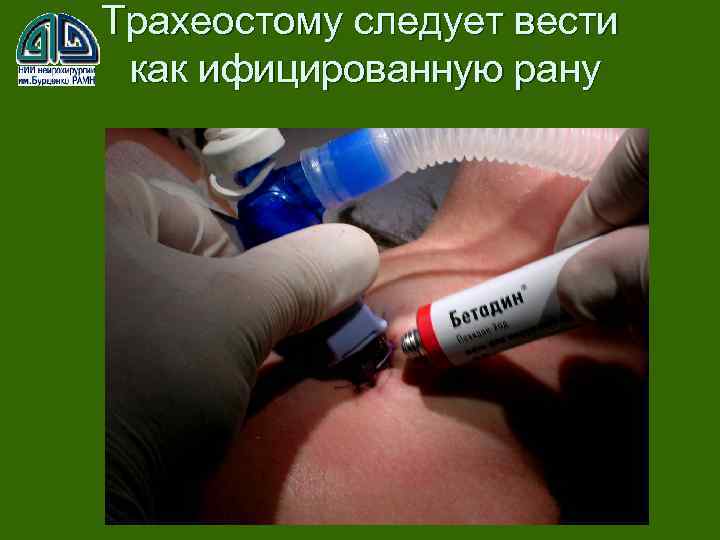 Трахеостому следует вести как ифицированную рану 