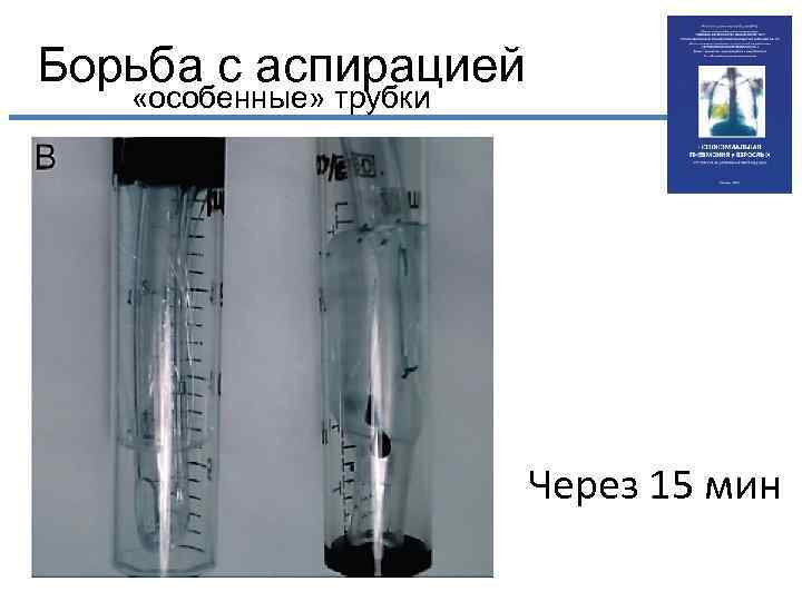 Борьба с аспирацией «особенные» трубки Через 15 мин 