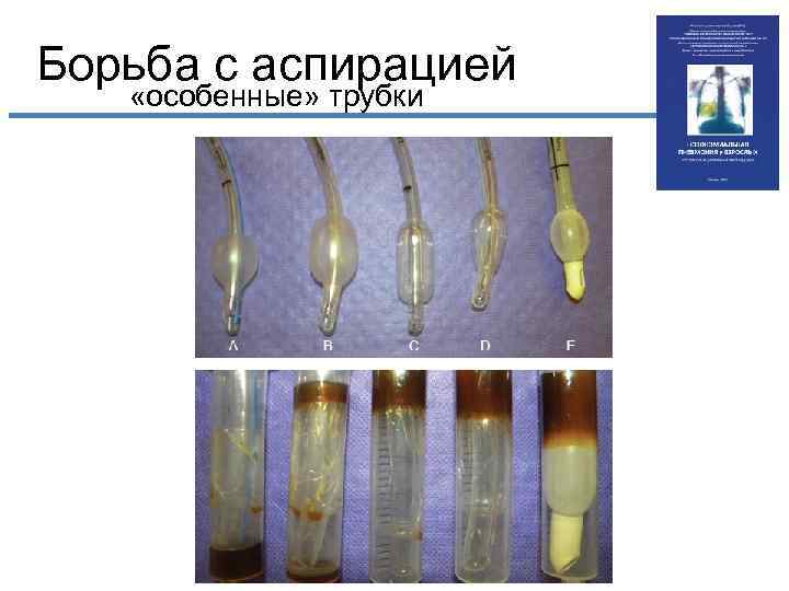 Борьба с аспирацией «особенные» трубки 