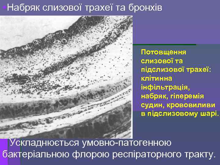§Набряк слизової трахеї та бронхів Потовщення слизової та підслизової трахеї: клітинна інфільтрація, набряк, гіперемія
