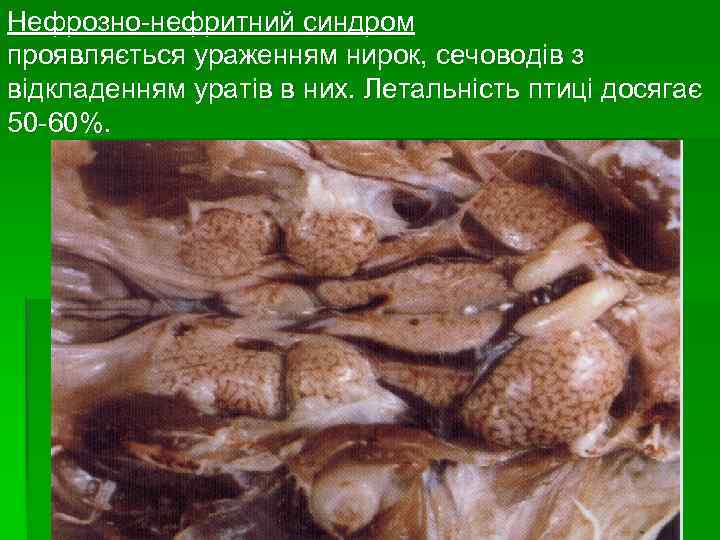 Нефрозно-нефритний синдром проявляється ураженням нирок, сечоводів з відкладенням уратів в них. Летальність птиці досягає