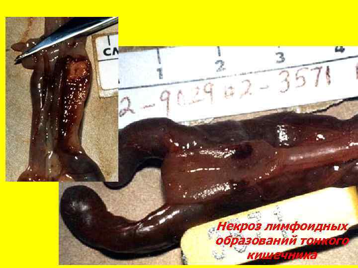 Некроз лимфоидных образований тонкого кишечника 