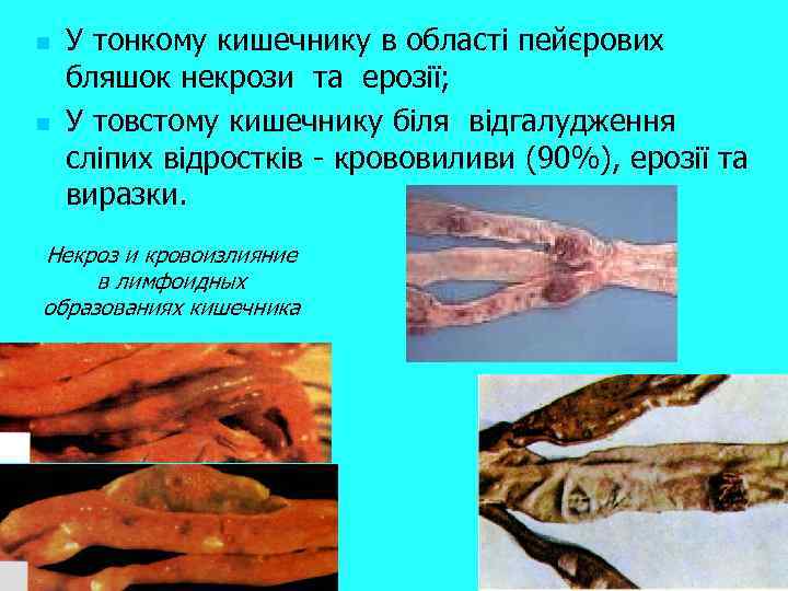 n n У тонкому кишечнику в області пейєрових бляшок некрози та ерозії; У товстому