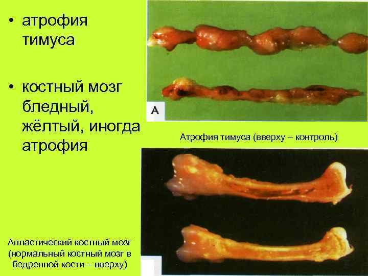  • атрофия тимуса • костный мозг бледный, жёлтый, иногда атрофия Апластический костный мозг