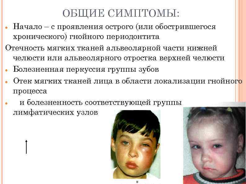 ОБЩИЕ СИМПТОМЫ: Начало – с проявления острого (или обострившегося хронического) гнойного периодонтита Отечность мягких