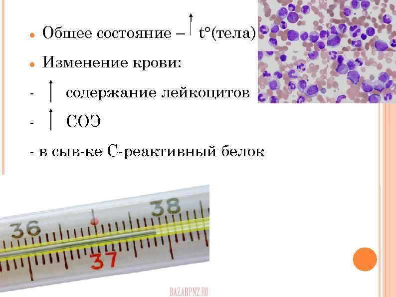  Общее состояние – t°(тела) Изменение крови: - содержание лейкоцитов - СОЭ - в