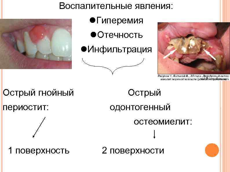 Инфильтрация гохзингера фото