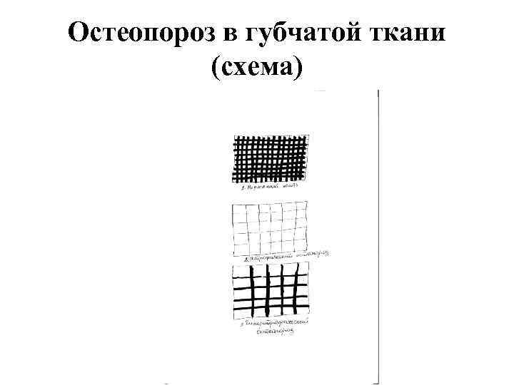 Остеопороз в губчатой ткани (схема) 