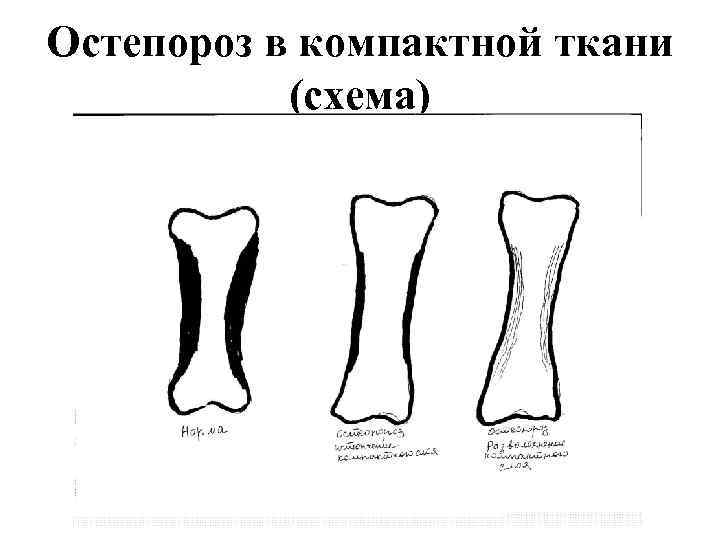 Остепороз в компактной ткани (схема) 