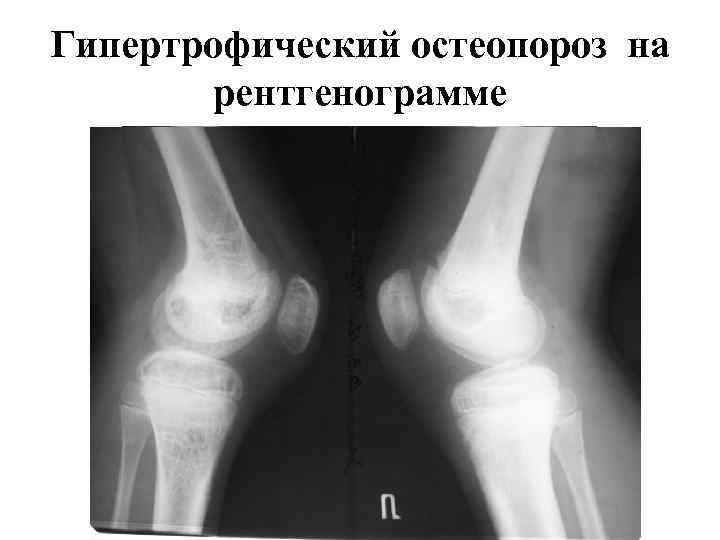 Гипертрофический остеопороз на рентгенограмме 