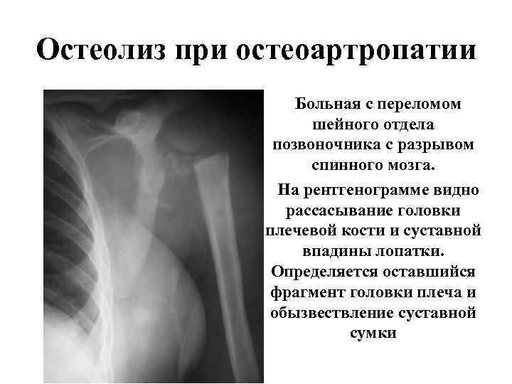 Остеолиз это. Остеолиз плечевого сустава. Остеолиз на рентгенограмме.