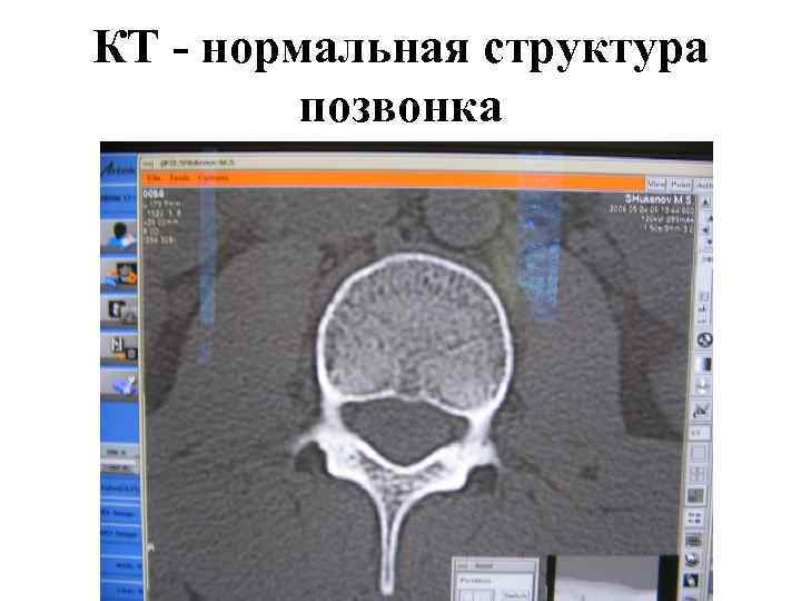 КТ - нормальная структура позвонка 
