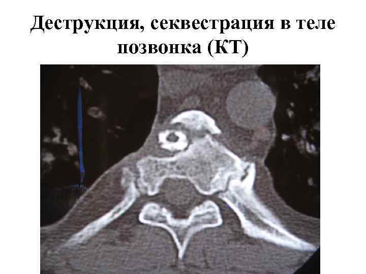 Кт картина краевой деструкции смежных костей наиболее характерна для