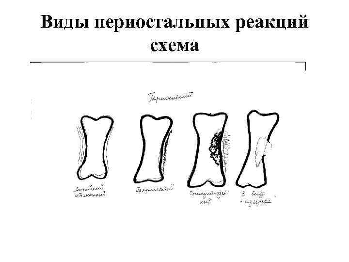 Виды периостальных реакций схема 
