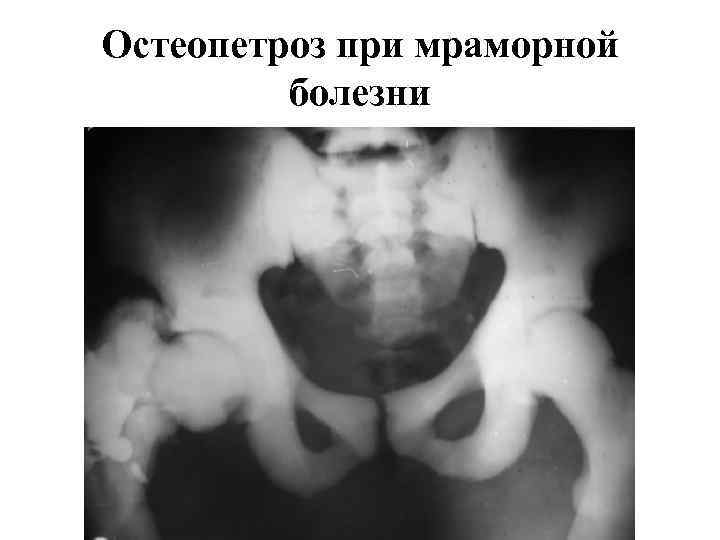 Остеопетроз при мраморной болезни 
