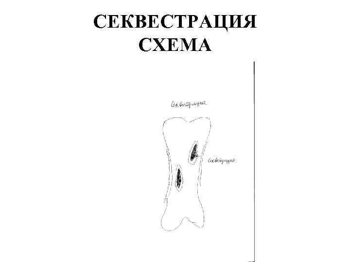 СЕКВЕСТРАЦИЯ СХЕМА 