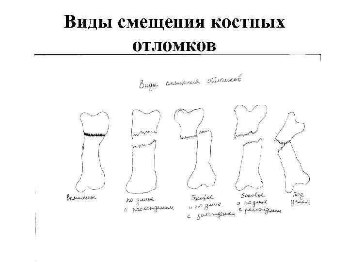 Смещение отломков кости