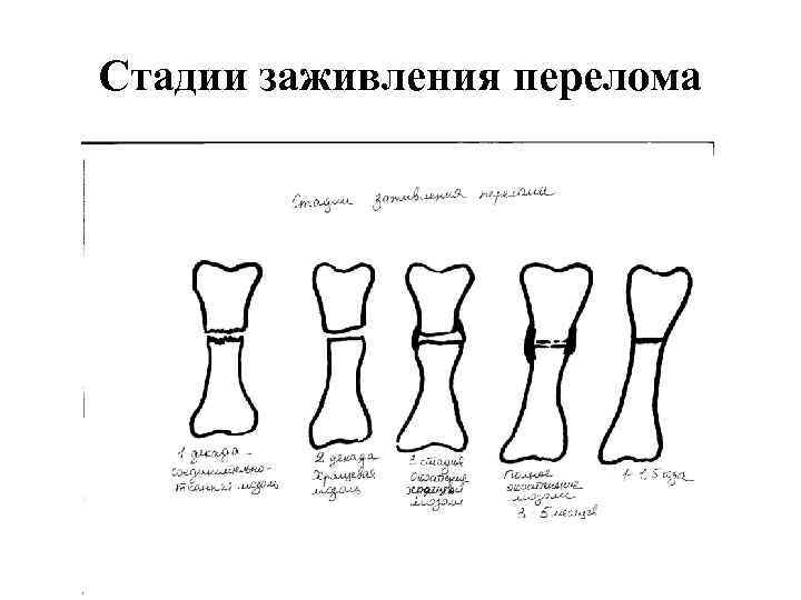 Сроки заживление переломов костей