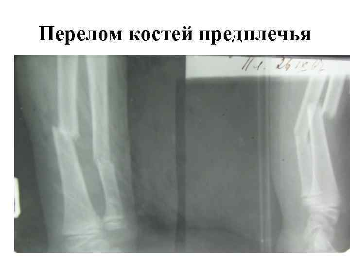 Перелом костей предплечья 