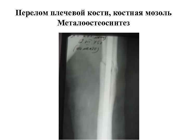 Костяная мозоль. Костная мозоль плечевой кости рентген. Периостальная костная мозоль рентген. Костная мозоль большеберцовой кости рентген. Эндостальная костная мозоль рентген.