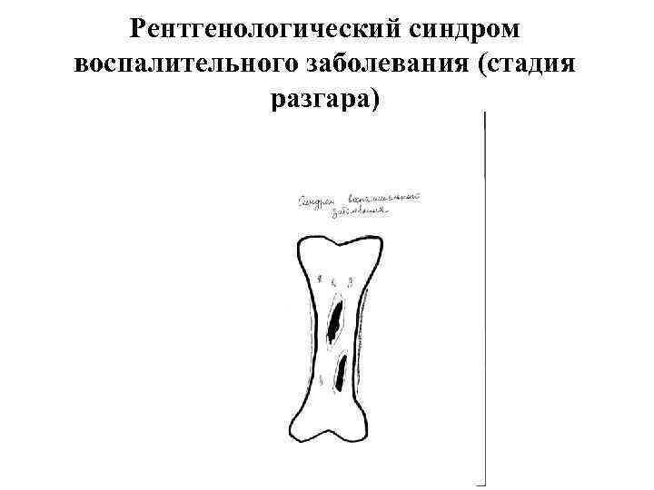 Рентгенологический синдром воспалительного заболевания (стадия разгара) 