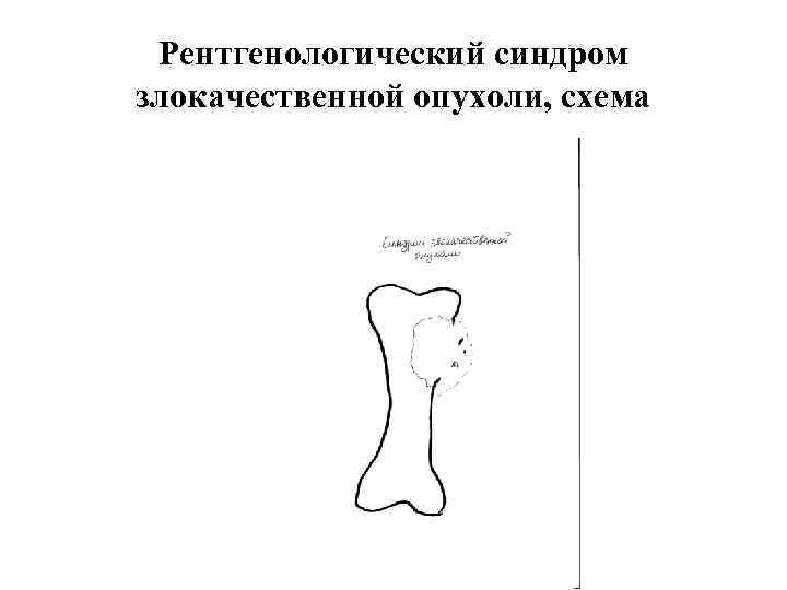 Рентгенологический синдром злокачественной опухоли, схема 