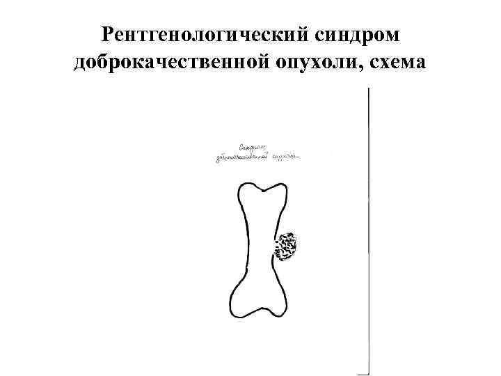 Рентгенологический синдром доброкачественной опухоли, схема 