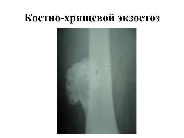 Костно-хрящевой экзостоз 