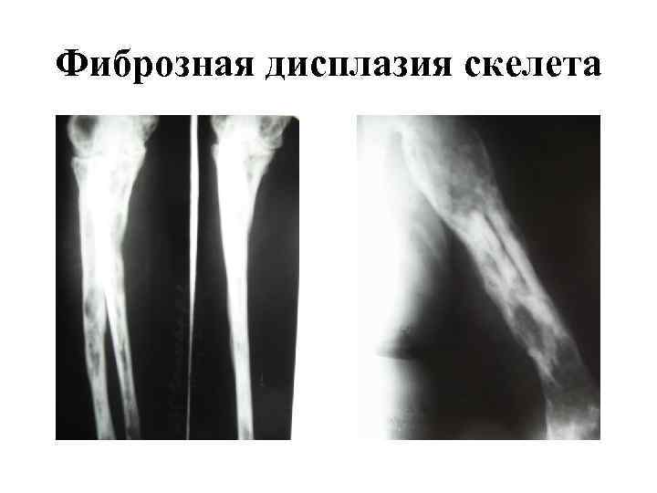 Фиброзная дисплазия скелета 