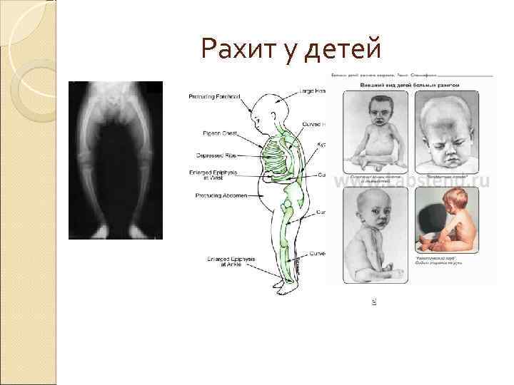 Рахит у детей