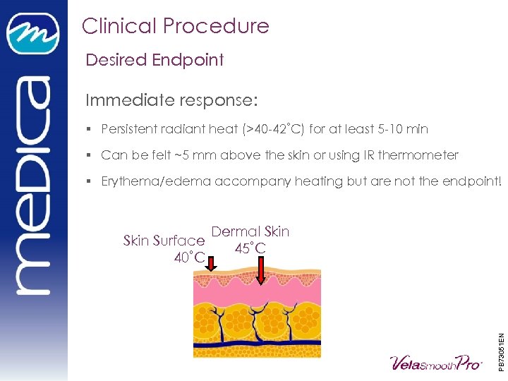 Clinical Procedure Desired Endpoint Immediate response: § Persistent radiant heat (>40 -42˚C) for at