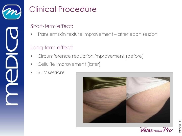 Clinical Procedure Short-term effect: § Transient skin texture improvement – after each session Long-term