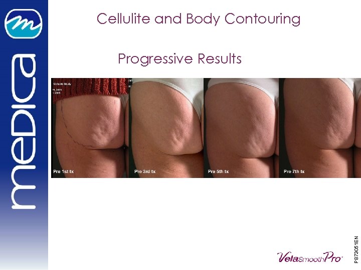 Cellulite and Body Contouring PB 73051 EN Progressive Results 