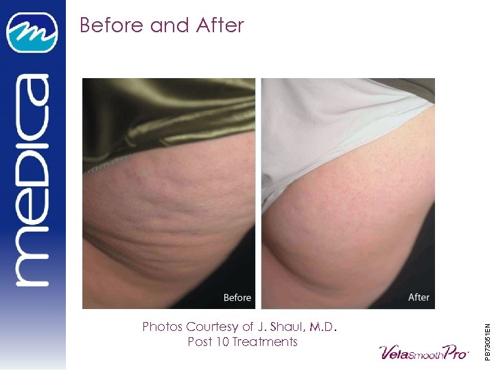 Photos Courtesy of J. Shaul, M. D. Post 10 Treatments PB 73051 EN Before