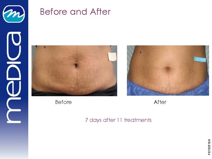 Before and After Before After PB 73051 EN 7 days after 11 treatments 