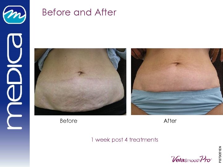 Before and After Before After PB 73051 EN 1 week post 4 treatments 
