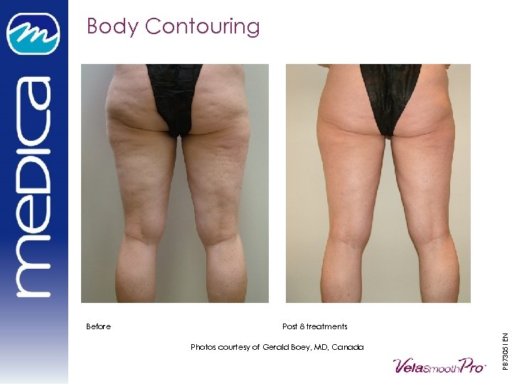 Body Contouring Post 8 treatments Photos courtesy of Gerald Boey, MD, Canada PB 73051