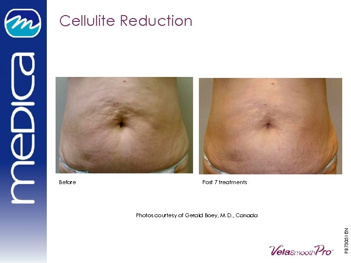 Cellulite Reduction Post 7 treatments Photos courtesy of Gerald Boey, M. D. , Canada